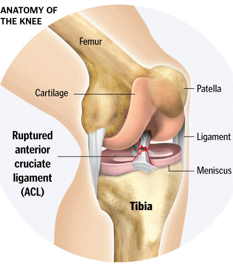 Cum ne protejam genunchii cand facem sport? 4 entorsa ligament