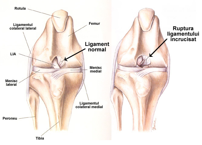 Cum ne protejam genunchii cand facem sport? 5 leziuni ale ligamentelor incrucisate anterioare lia 13